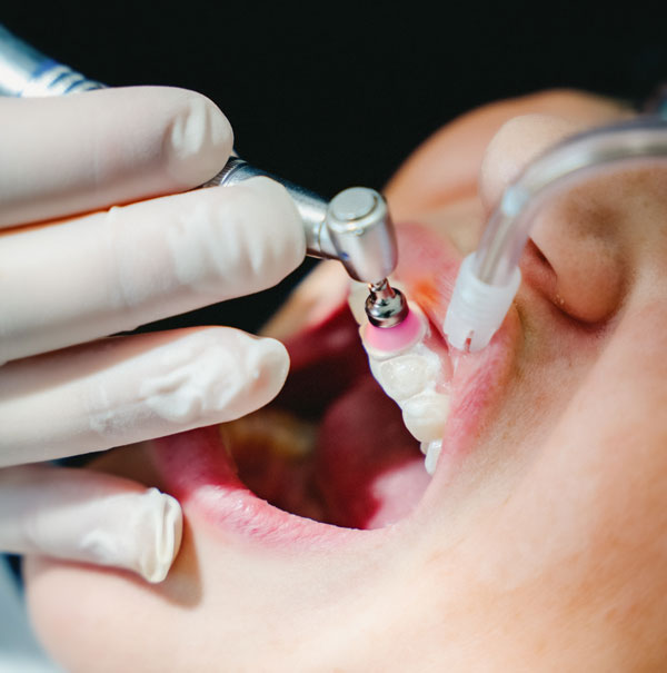 Politur der Zähne bei der professionellen Zahnreinigung im MVZ Rage-Holm Bocholt